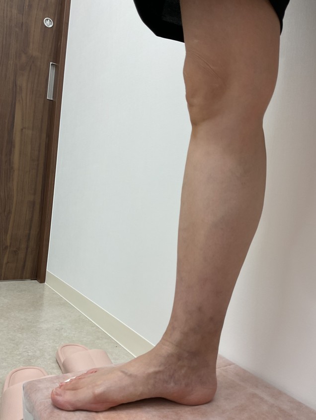 下肢静脈瘤の症例