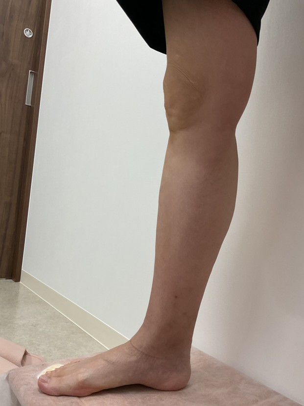 下肢静脈瘤の症例