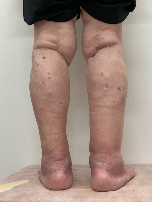 下肢静脈瘤の症例