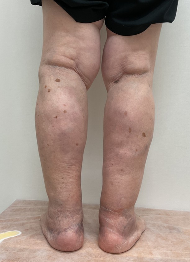 下肢静脈瘤の症例