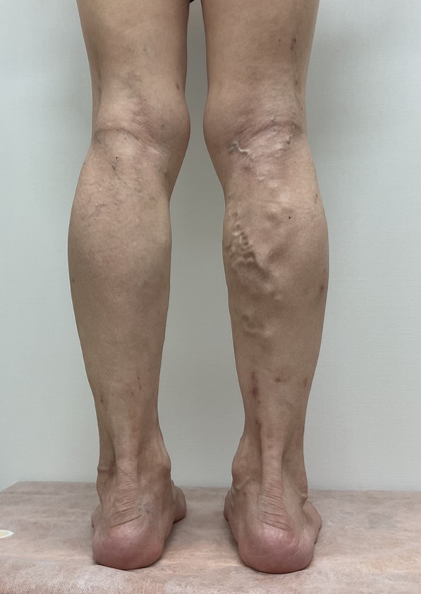 下肢静脈瘤の症例