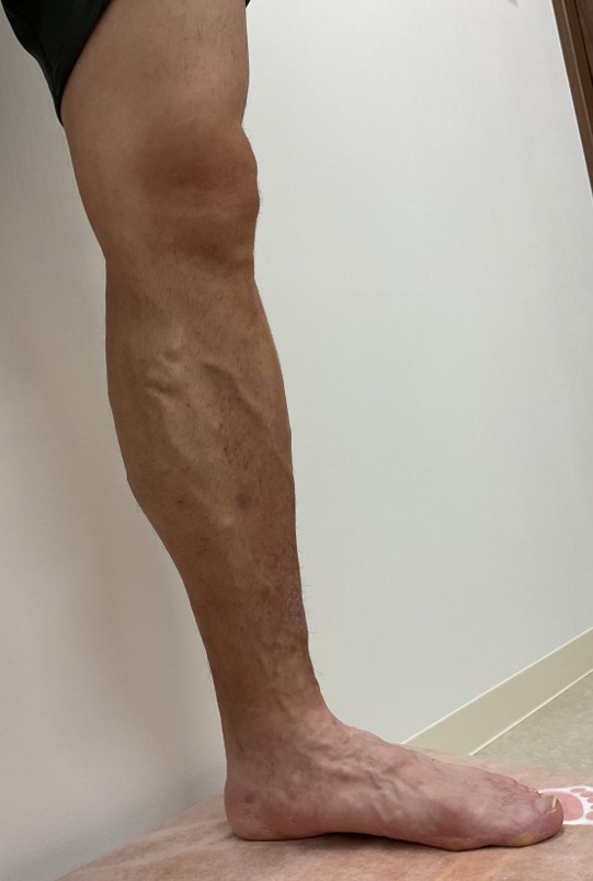 下肢静脈瘤の症例