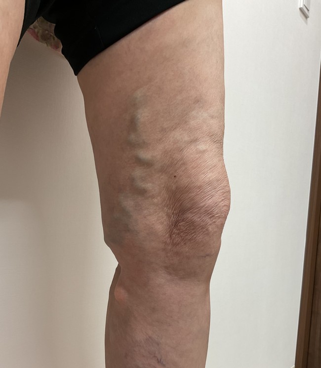 下肢静脈瘤の症例