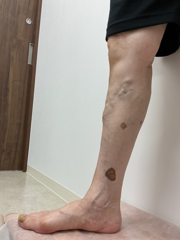 下肢静脈瘤の症例