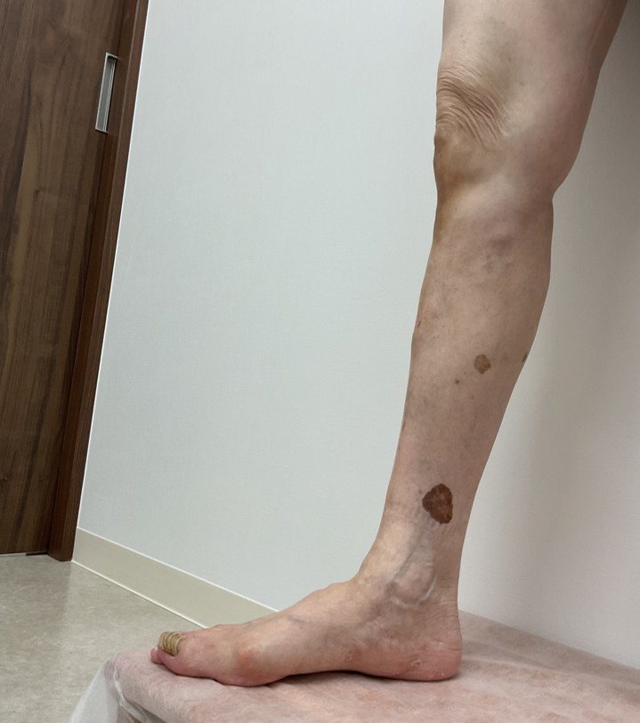 下肢静脈瘤の症例