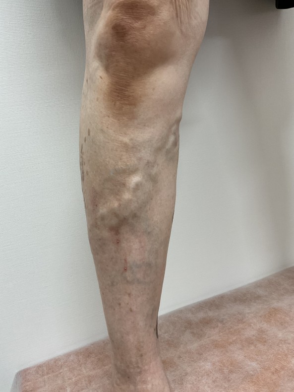 下肢静脈瘤の症例