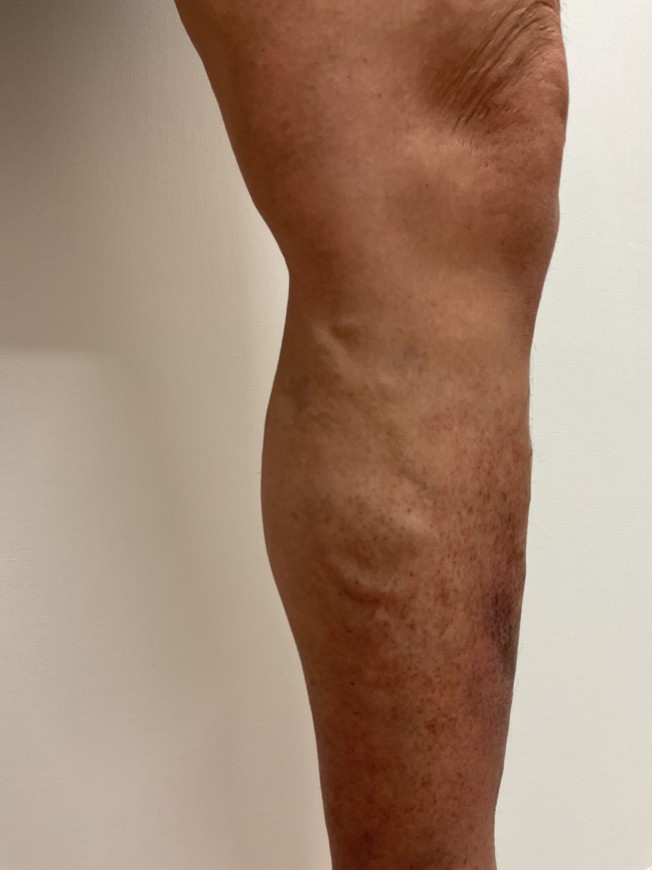 下肢静脈瘤の症例