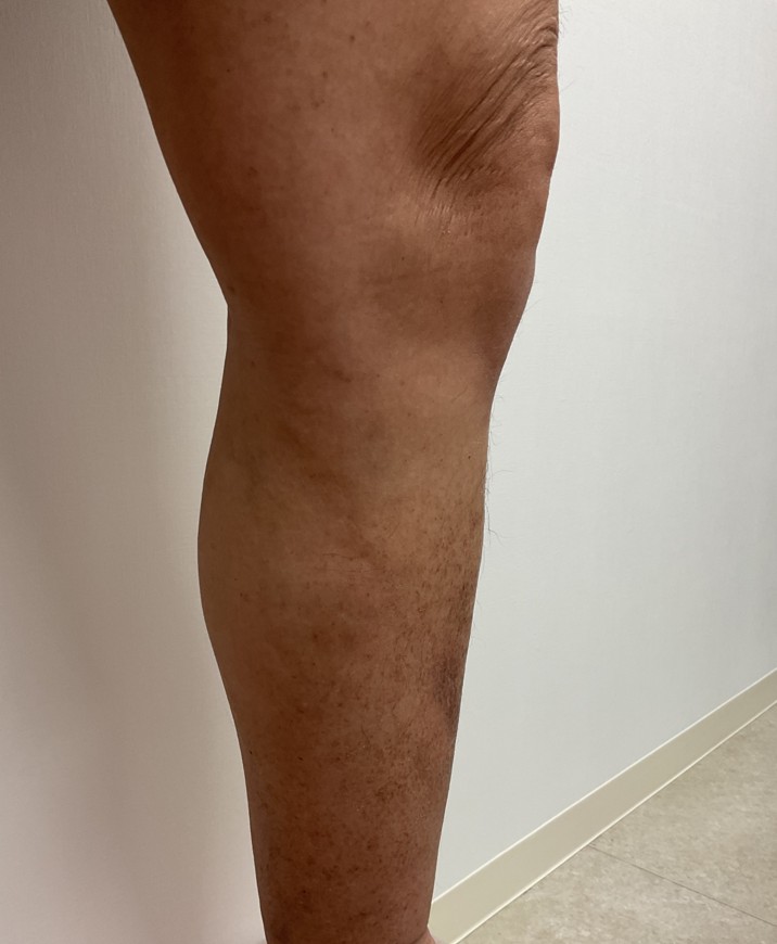 下肢静脈瘤の症例