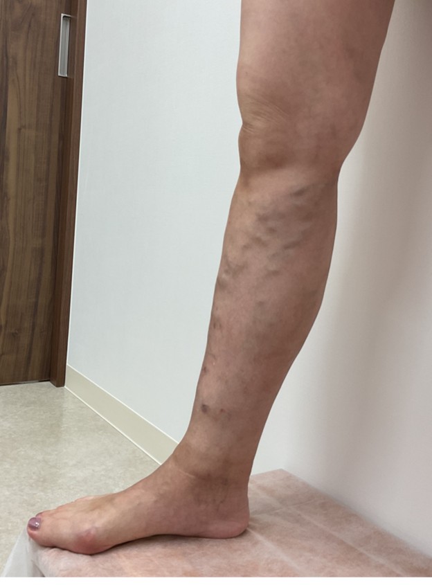 下肢静脈瘤の症例